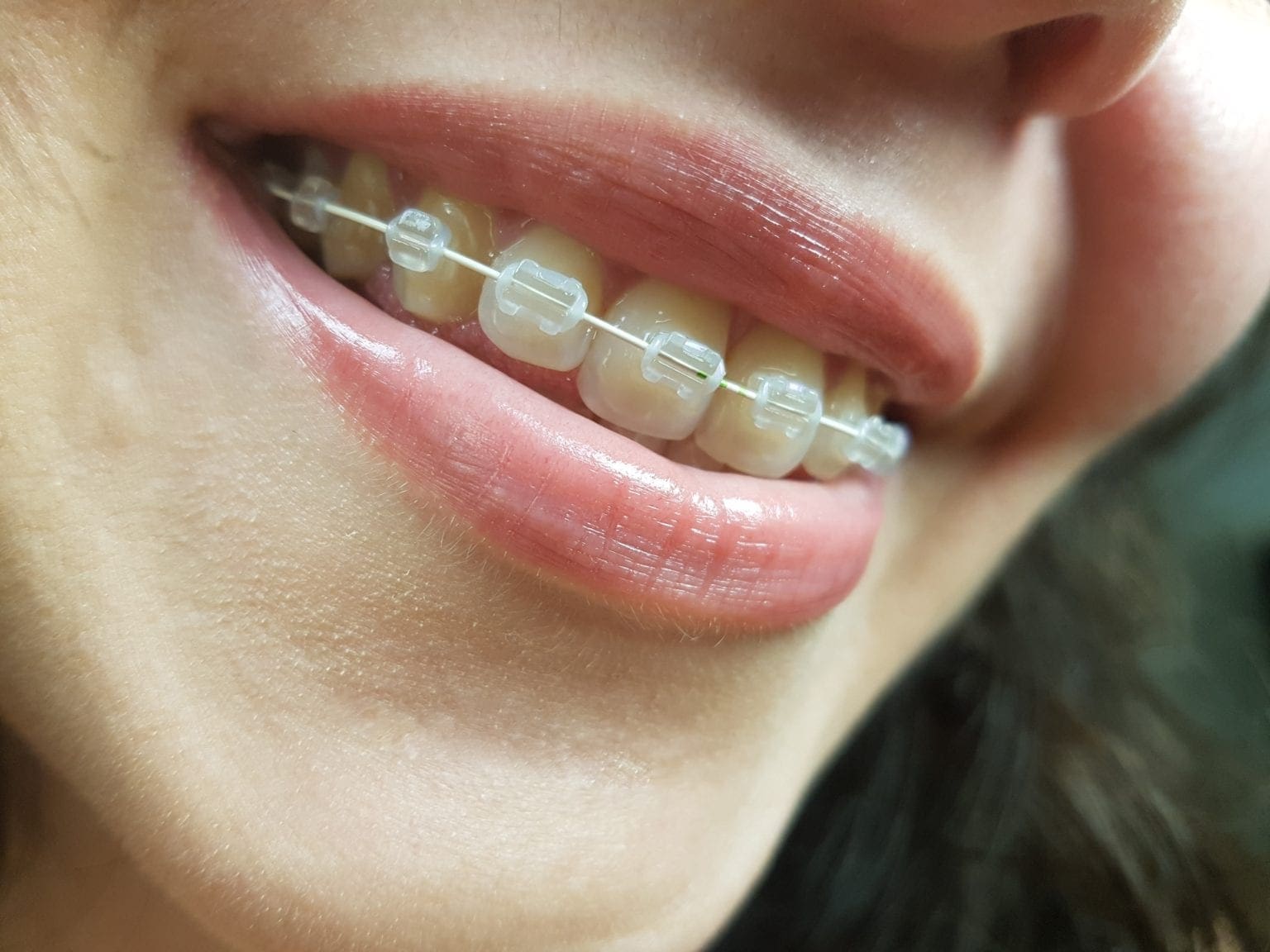 Roeder Orthodontics I How Much Do Braces Cost? I Asheville