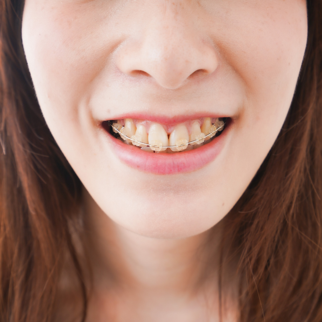 Clear braces Clear braces